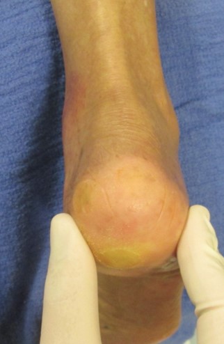 The thickness of heel fat-pad in patients with plantar fasciitis. -  Abstract - Europe PMC