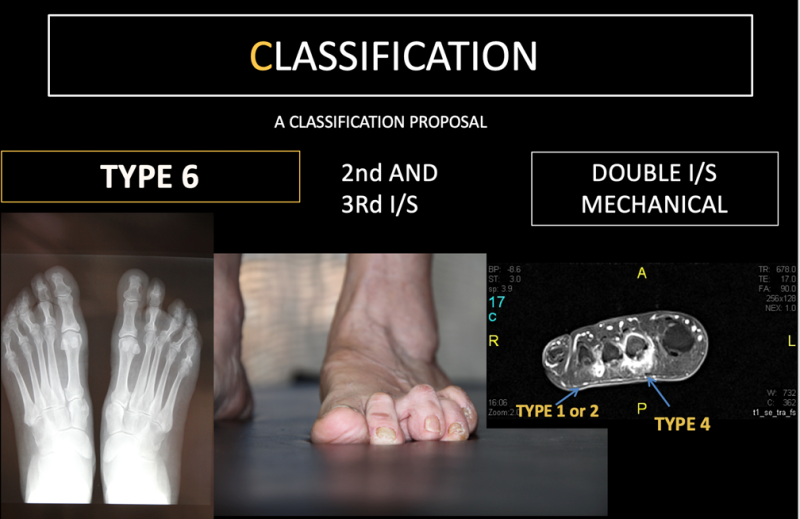 New Classification for Morton's 